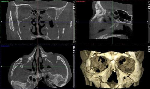 КТ лицевых костей